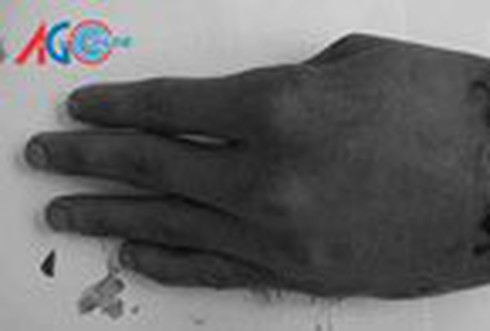 Nhậu quậy, bị chém đứt lìa bàn tay - ảnh 1