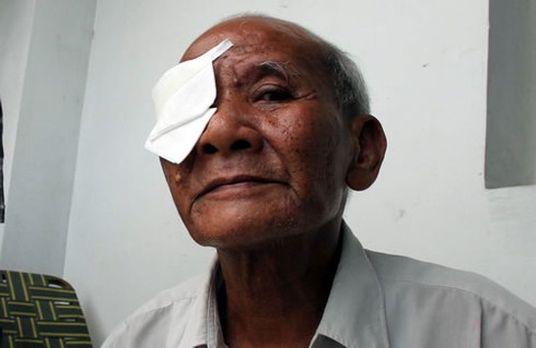 Mù, biến chứng hàng loạt sau phẫu thuật mắt ở BVĐK khu vực Quảng Nam - ảnh 2