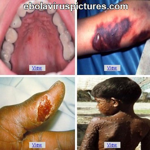 Triệu chứng ủ bệnh Ebola từ 2- 21 ngày như thế nào? - ảnh 1