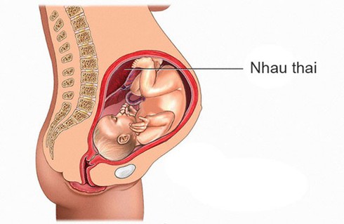 Cứu sống mẹ con sản phụ bị tai nạn lòi nhau thai - ảnh 1
