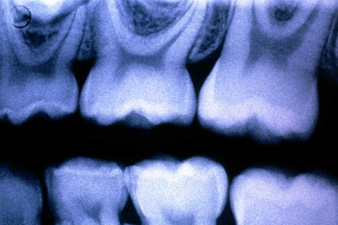 Men răng tiến hóa từ vảy cá cổ đại? - ảnh 1