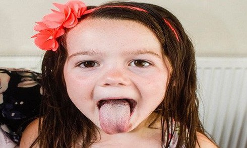 Bé gái 5 tuổi có một nửa cơ thể lớn nhanh hơn nửa còn lại - ảnh 1