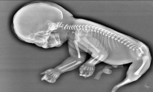 Thai nhi mọc đuôi như nàng tiên cá trong bụng mẹ - ảnh 1