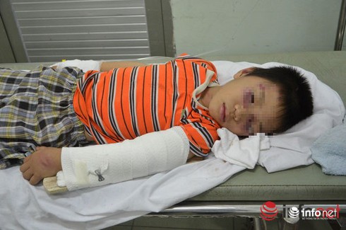 Khởi tố “cha dượng” đánh gãy tay, chân con riêng của vợ - ảnh 2