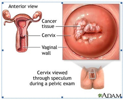 Bệnh sùi mào gà gây ung thư như thế nào? - ảnh 1