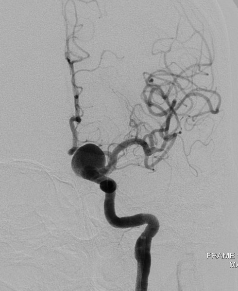 Cấp cứu một ca phình động mạch máu não bằng phương pháp hiện đại - ảnh 1