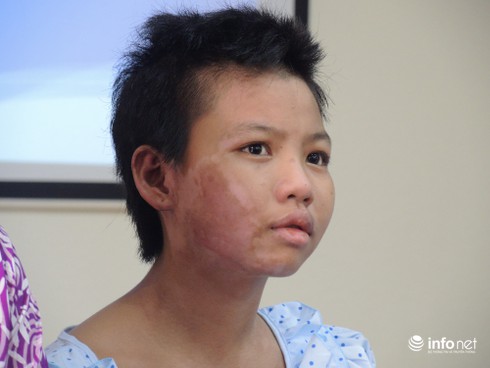 Bé gái bán vé số bị mẹ đốt tươi cười trong ngày xuất viện - ảnh 1