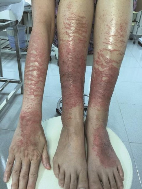 Những nạn nhân thảm thương của corticoid - ảnh 2