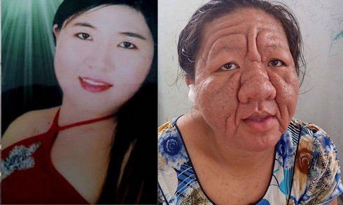 Những nạn nhân thảm thương của corticoid - ảnh 3