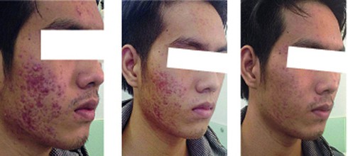 Những nạn nhân thảm thương của corticoid - ảnh 1
