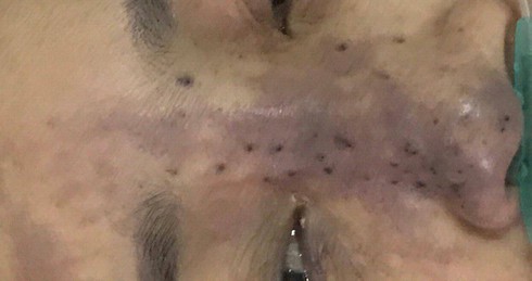 Má nổi cục, chảy mủ sau khi bơm chất làm đẹp - ảnh 1