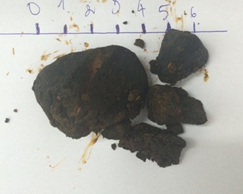 TP.HCM: Cứu sống bệnh nhân sốc nhiễm trùng đường mật - ảnh 2