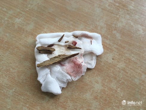 Hy hữu: 10 mảnh gỗ găm sâu trong khoang xương mặt hơn 1 năm - ảnh 2