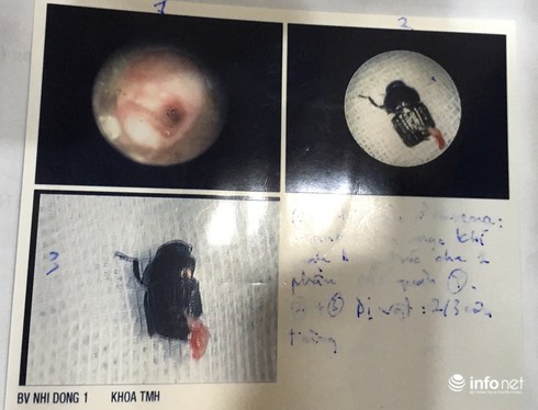 Hy hữu: Con bọ dài 2cm bay thẳng vào cổ họng bé 8 tháng - ảnh 2