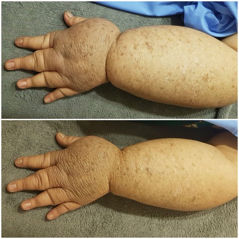 15 năm sống chung với “tay voi” vì phù nề bạch huyết