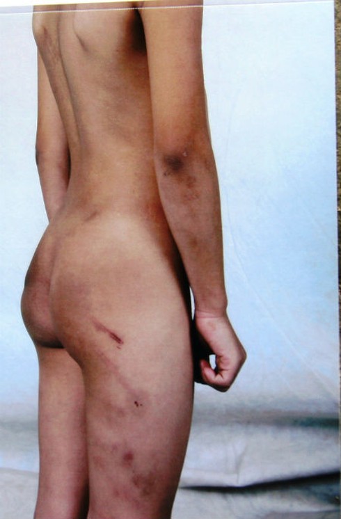 Cháu bé bị bố và mẹ kế đánh gãy xương sườn vẫn rên khóc mỗi đêm - ảnh 1