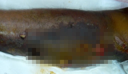 “Vi khuẩn ăn thịt người” xuất hiện ở Việt Nam - ảnh 2