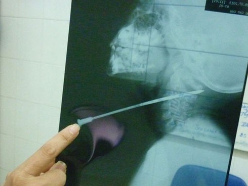 Ngã từ ghế xuống, cháu bé bị nan hoa xuyên cổ - ảnh 1