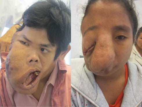 Trước giờ phẫu thuật 2 bệnh nhân có gương mặt biến dạng - ảnh 1