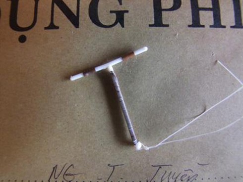 Đặt vòng tránh thai vào... ruột! - ảnh 2