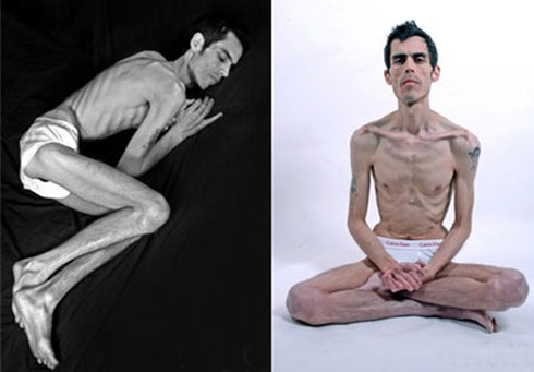 6 người mẫu chết thảm vì biếng ăn - ảnh 4