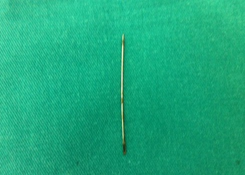 Nằm đè lên kim, tim bị đâm thấu - ảnh 1