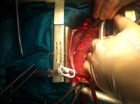 Nằm đè lên kim, tim bị đâm thấu - ảnh 2