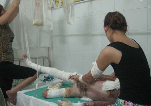 BHYT cân nhắc thanh toán viện phí cho gia đình bị tạt axit - ảnh 1