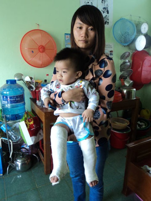 Gửi ở nhà trẻ tư, bé trai gãy cả 2 chân - ảnh 1