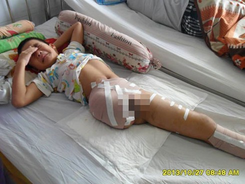 Bé trai phải cắt bỏ chân sau TNGT: Một gia đình khốn đốn - ảnh 1