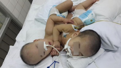 TP.HCM: Phẫu thuật tách cặp song sinh dính liền tim, gan - ảnh 1