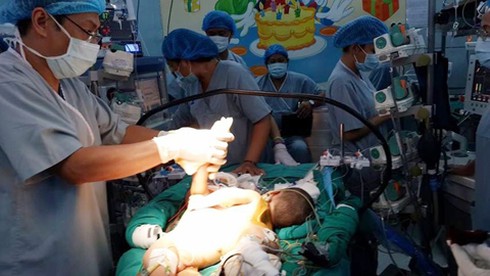 TP.HCM: Phẫu thuật tách cặp song sinh dính liền tim, gan - ảnh 2
