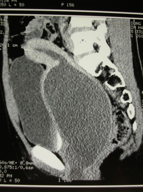 Màng trinh không lỗ thoát, bé gái đau bụng dữ dội - ảnh 1