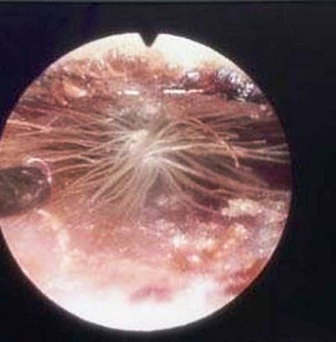 Những dị vật kinh hoàng mắc kẹt trong lỗ tai người - ảnh 4