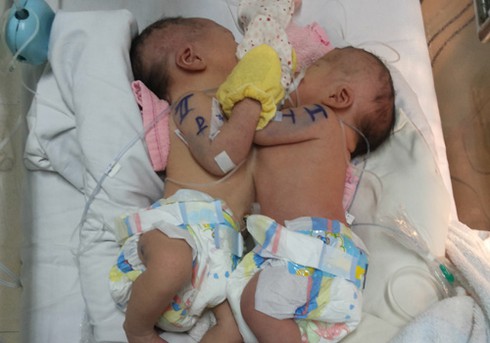 Thêm 2 bé sơ sinh dính ngực: Cả hai đều bị bệnh tim - ảnh 1