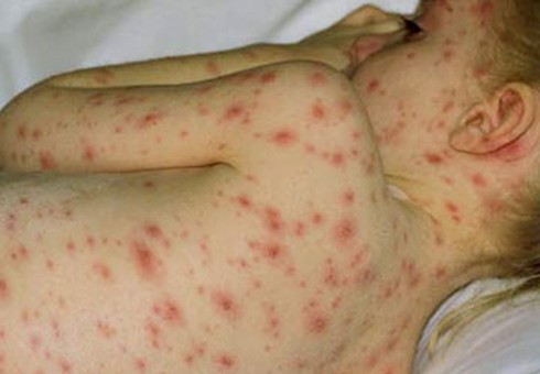 Gần 80.000 liều vaccine thủy đậu đã nhập về Việt Nam - ảnh 1