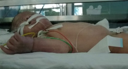Sau tiêm phòng lao, cánh tay cháu bé bị hoại tử nặng - ảnh 1