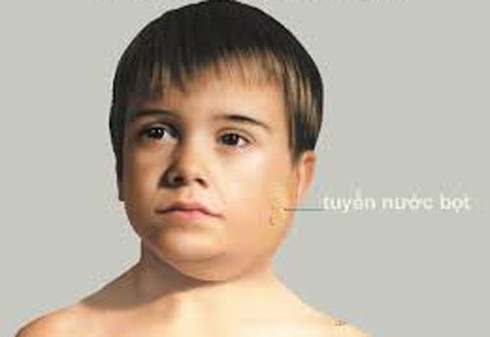 Biến chứng khi bị quai bị là gì? - ảnh 1