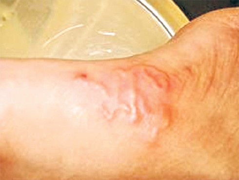 Dùng thuốc điều trị giun sán đúng cách - ảnh 1