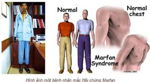 Quá gầy, có phải tôi bị hội chứng Marfan? - ảnh 1