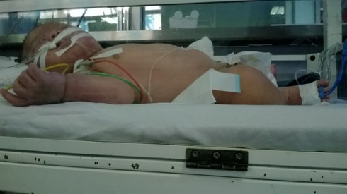 Bệnh nhi bị hoại tử cánh tay sau tiêm phòng lao đã tử vong - ảnh 1