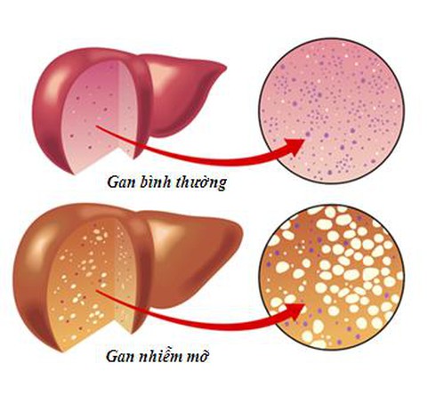 Gan nhiễm mỡ: Chế độ ăn uống phải nghiêm ngặt như thế nào? - ảnh 1