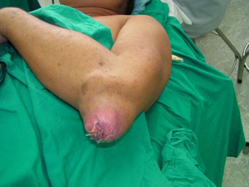 Vì sao mắc bệnh gút lại suy giảm “chuyện ấy”? - ảnh 1