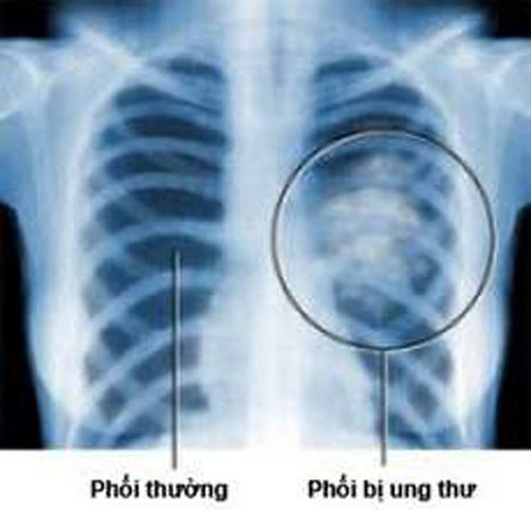 Ung thư phổi: Những triệu chứng đầu tiên - ảnh 1