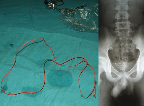 Thách đố bạn bè, nuốt dây điện dài gần 0,5 m - ảnh 1