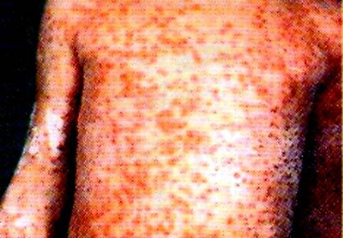 Bệnh sởi: Triệu chứng, diễn biến bệnh, nguyên nhân và cách điều trị - ảnh 1