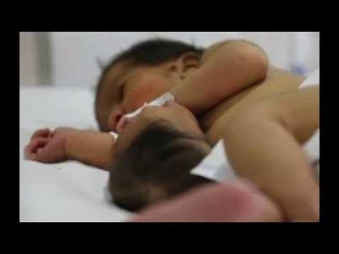 Bé song sinh dính liền: Đầu mọc ra từ bụng - ảnh 1