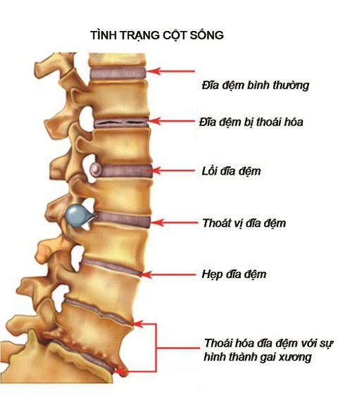 Gai cột sống: Nguyên nhân, triệu chứng và biến chứng - ảnh 1