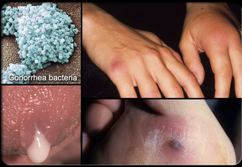 Khiếp đảm những hình ảnh bệnh lây qua đường tình dục - ảnh 8