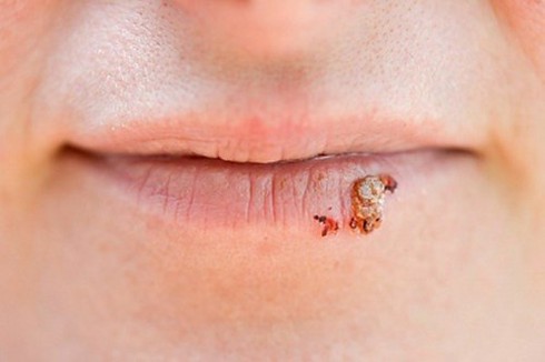 Khiếp đảm những hình ảnh bệnh lây qua đường tình dục - ảnh 10